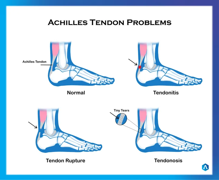Diagram comparing a normal Achilles tendon with tendonitis, rupture and tendonosis