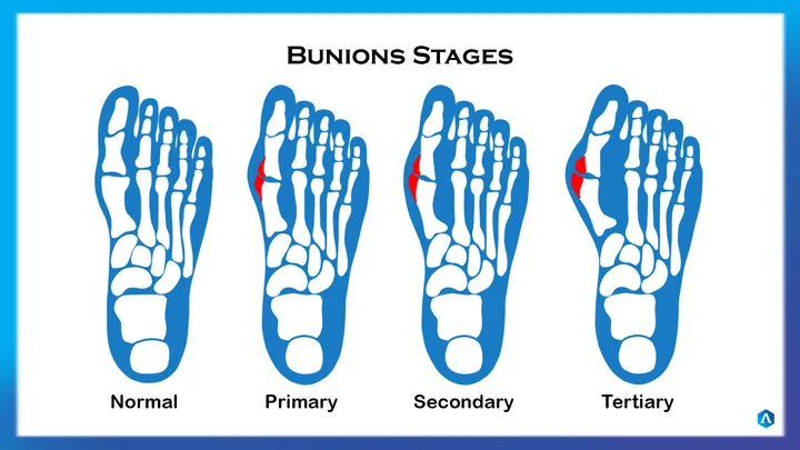 Diagram of the four stages of a bunion, from a normal foot to the tertiary stage