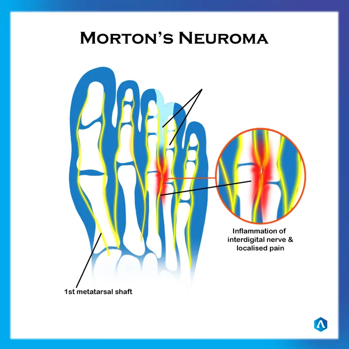 Diagram of Morton’s neuroma between the metatarsals