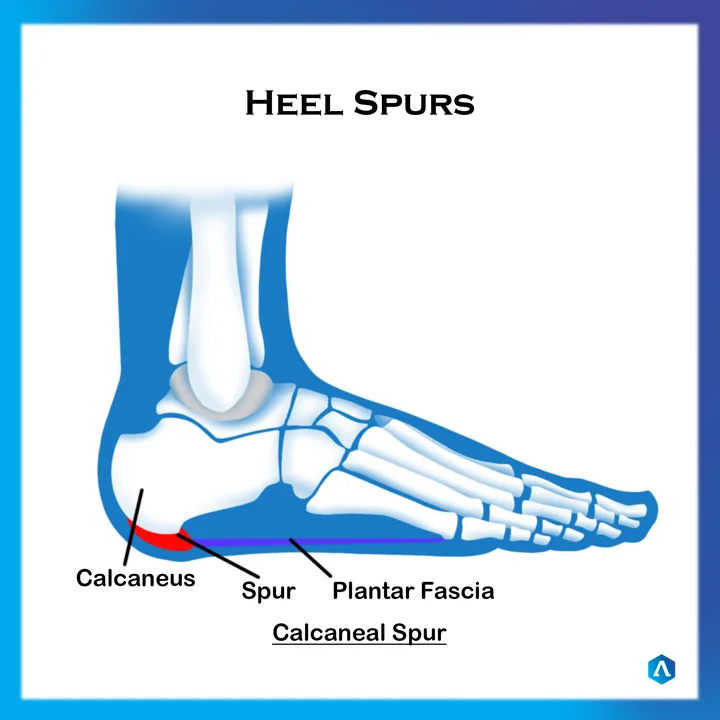 Diagram of a heel spur and the calcaneal attachment of the plantar fascia