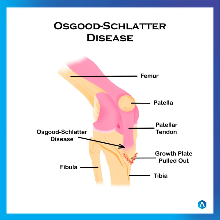 Diagram of Osgood-Schlatter disease, showing the patellar tendon pulling on the growth plate at the top of the shin bone