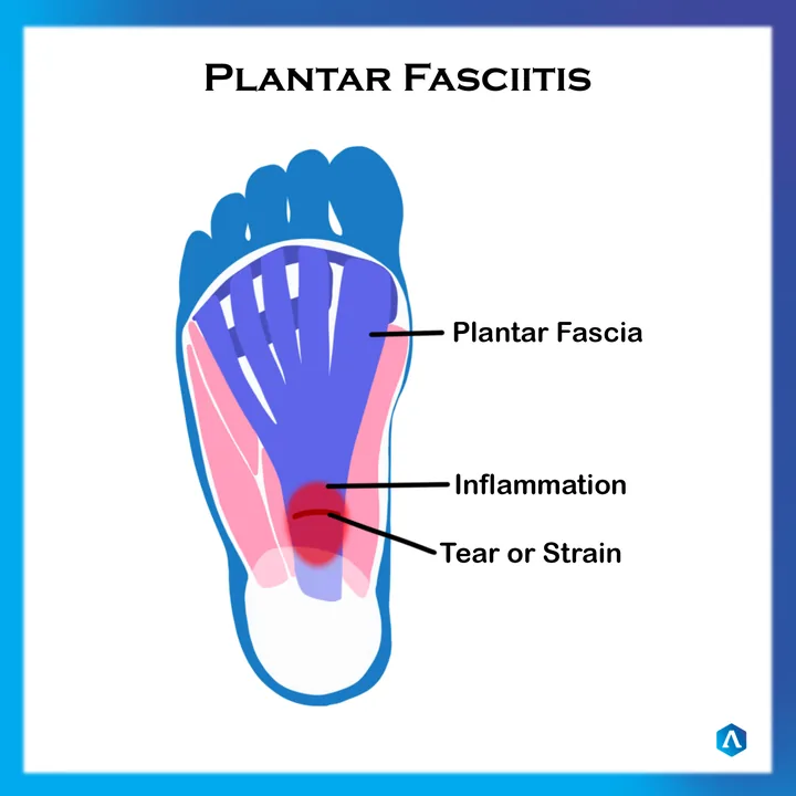Diagram of the plantar fascia showing inflammation and tearing