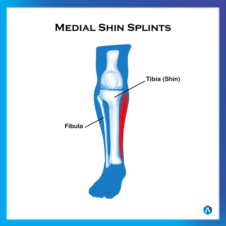 Diagram of medial shin splints along the tibia