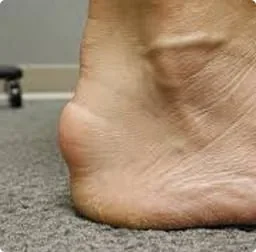 A thickened Achilles tendon at the back of the heel