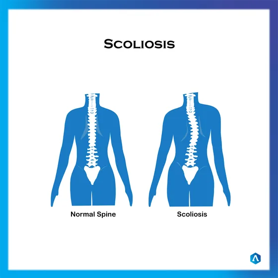 Diagram comparing a normal spine with a spine curved by scoliosis