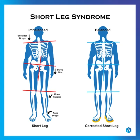 Diagram of short leg syndrome and the body corrected to level