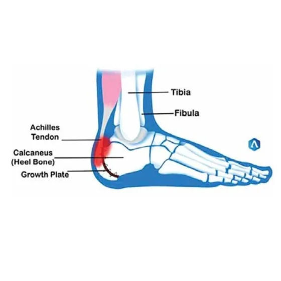 Diagram of Sever’s disease at the heel growth plate