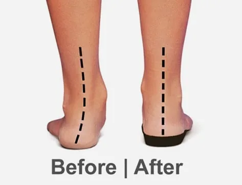 Heels rolling in before an orthotic and upright after it