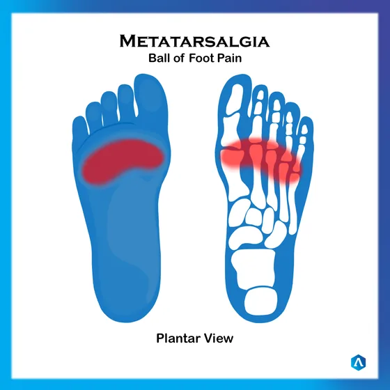 Diagram of metatarsalgia, pain across the ball of the foot