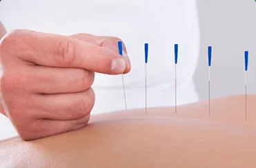 Fine needles placed in a muscle