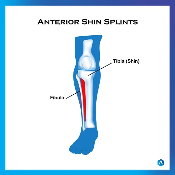 Diagram of anterior shin splints along the front of the shin