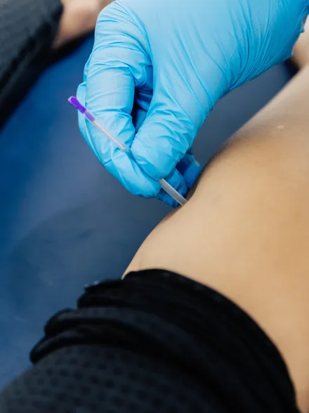 Dry needling being applied to a patient’s lower leg
