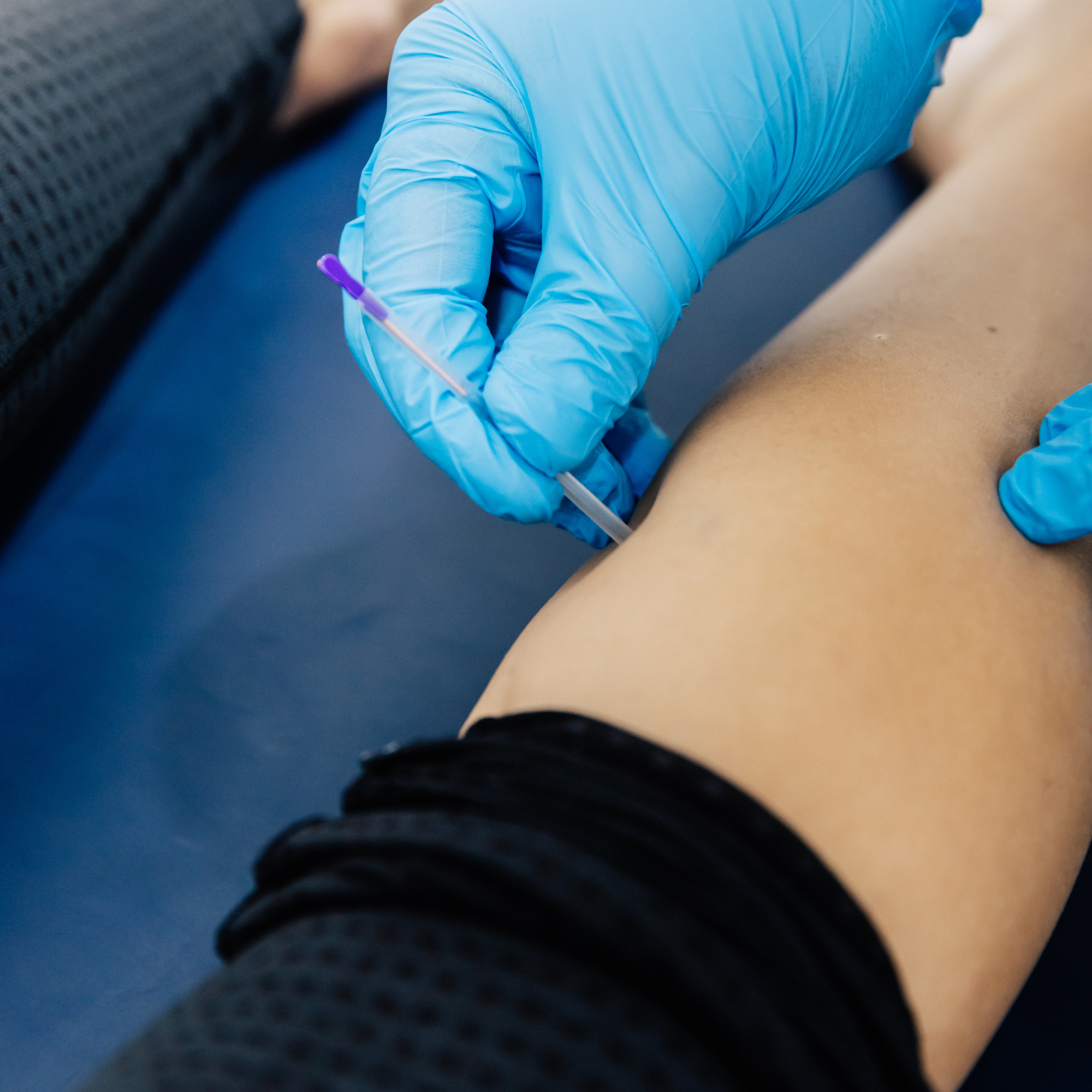 Dry Needling