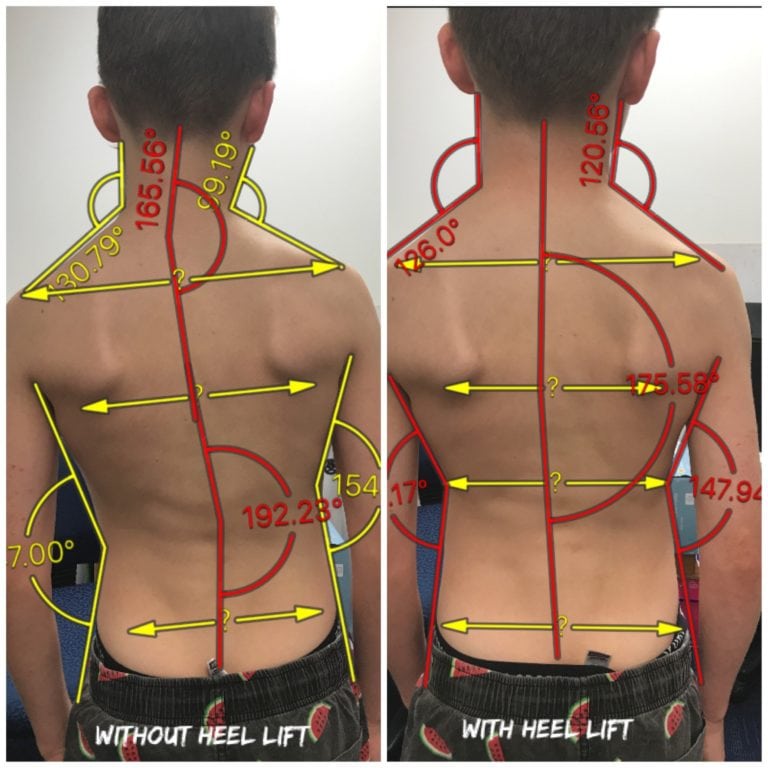 Boy_heel-lift-fix-768x768