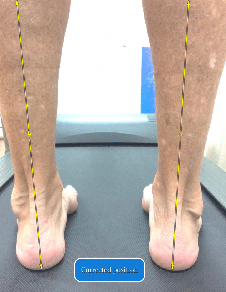 Ankle and Knee Pain when Running Downhill Dr. Abbie Clinics