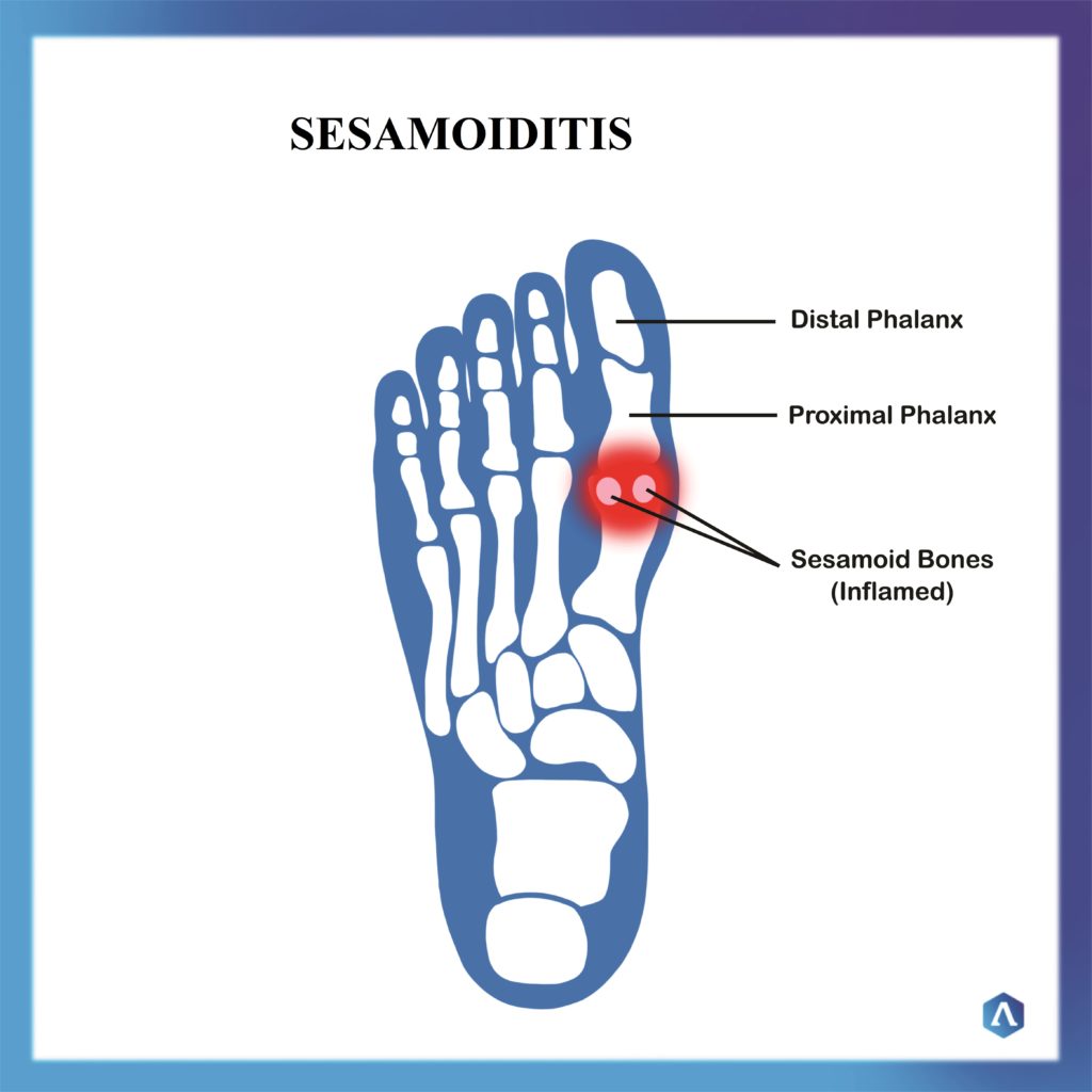 272 Will a bone stimulator help sesamoiditis? - DOC