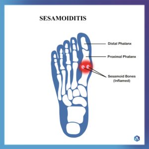 Sesamoiditis