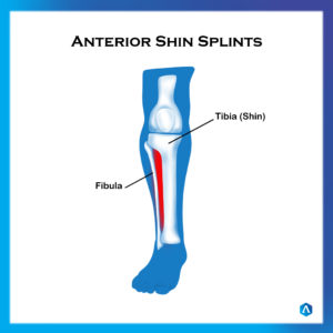 Shin Splint Ant