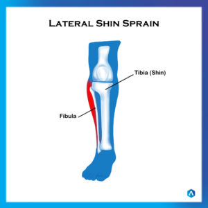 Shin Splint Lateral
