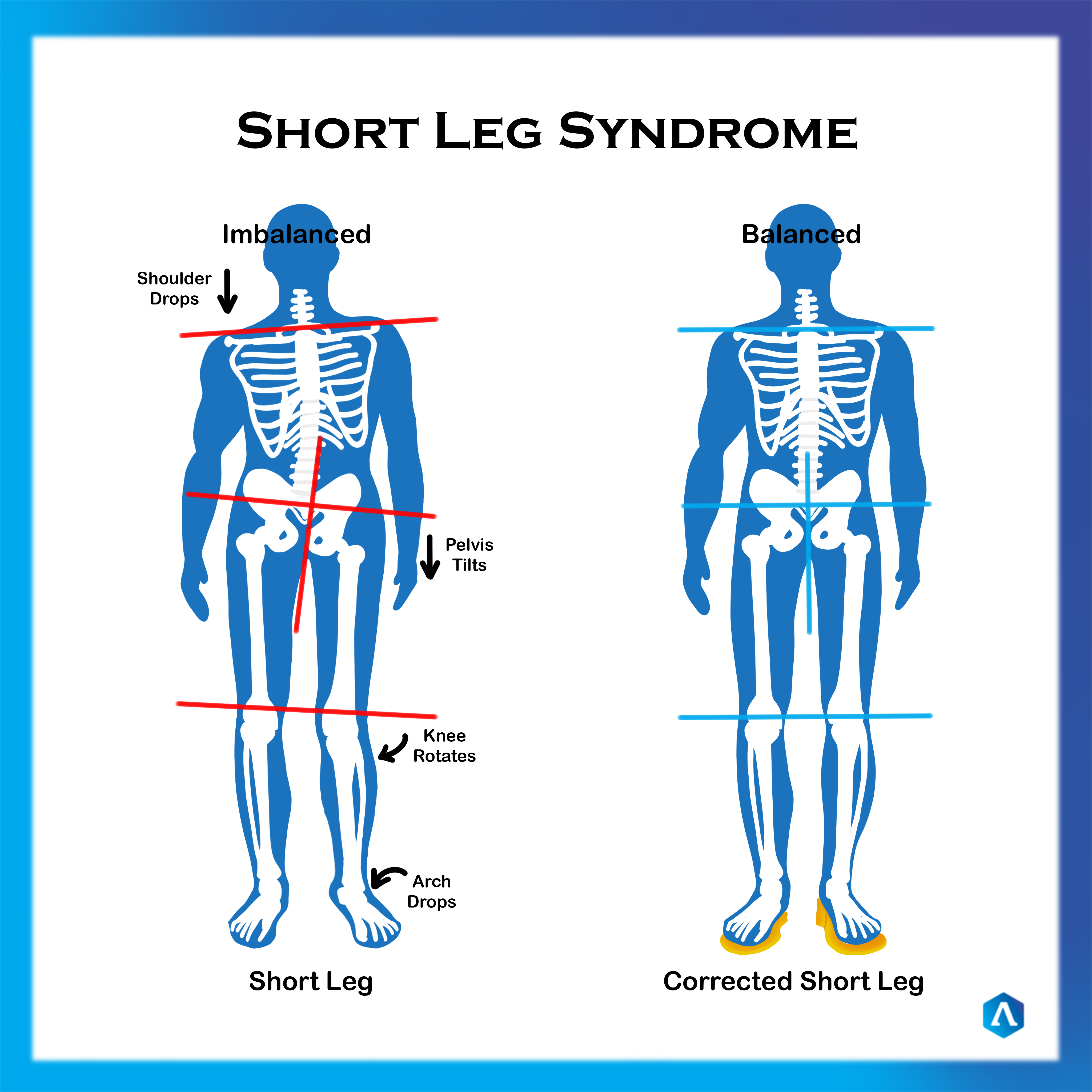 What is Short Leg Syndrome?: Restore Orthopedics and Spine Center