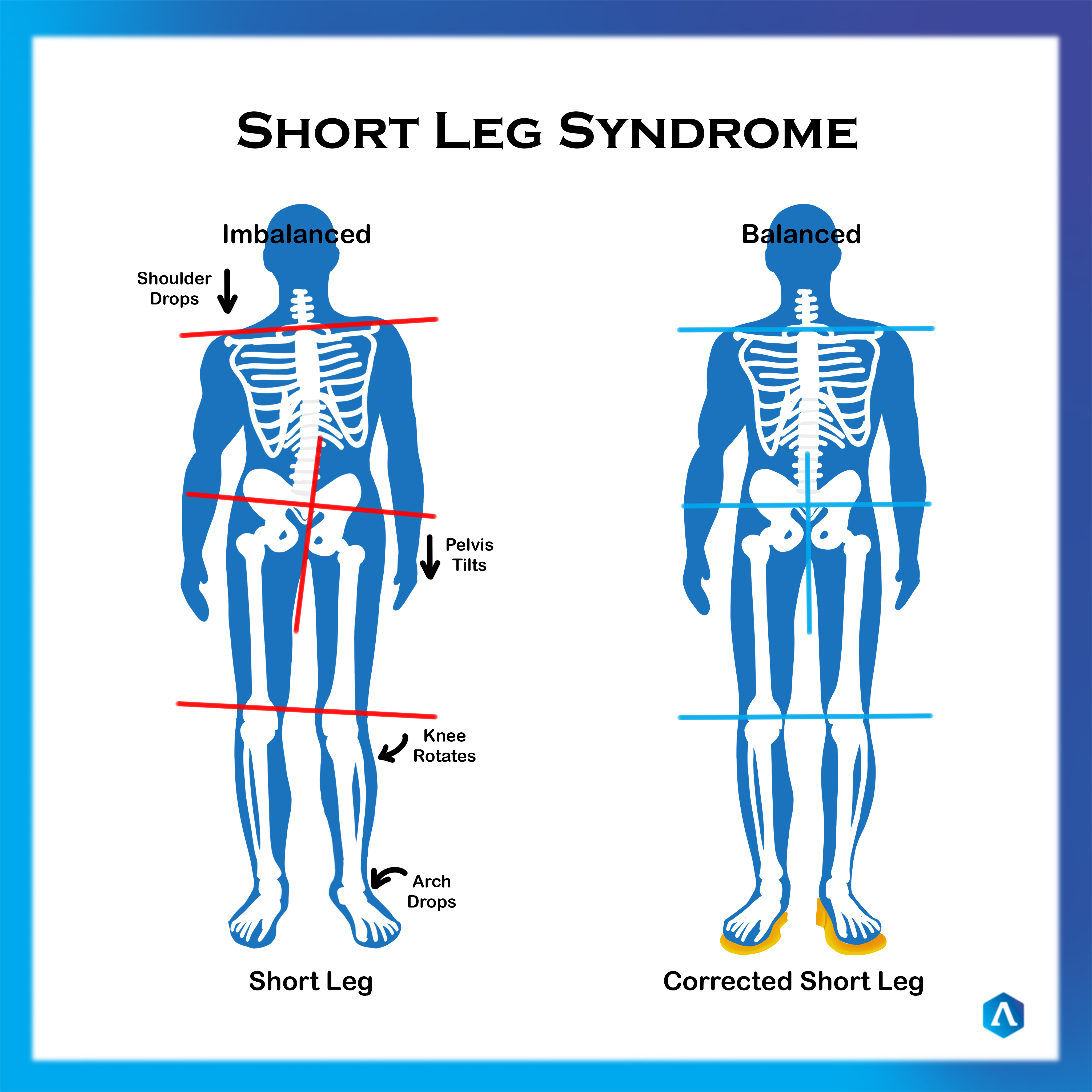 Glossary Long Leg - Short Leg