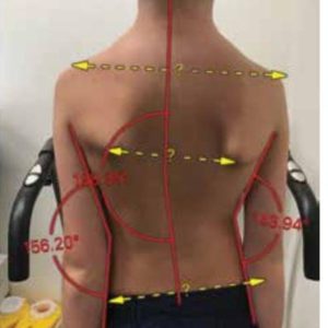 Scoliosis in Children
